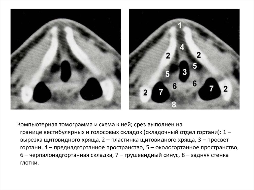 Гортань кт анатомия. Грушевидные синусы гортани на кт. Образование гортани на кт.
