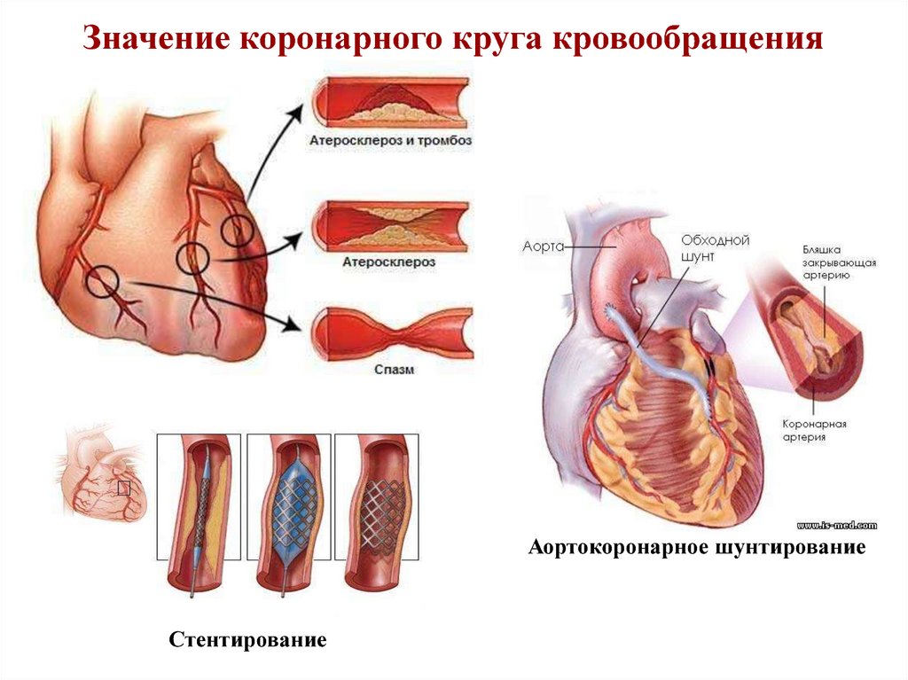 Что такое шунтирование сердца и сосудов. Схема операции аортокоронарного шунтирования. Коронарное шунтирование сосудов сердца. Аорта коронарное шунтирование. Аортокоронарное шунтирование ход операции.