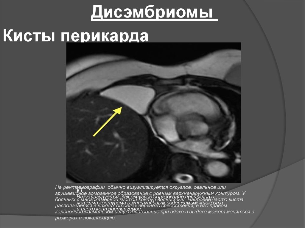 Кисты средостения презентация