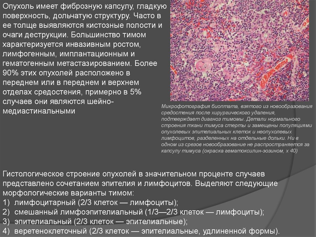 Частые опухоли. Гистологическое строение опухоли. Строение злокачественной опухоли. Гистологическая структура опухоли злокачественных.