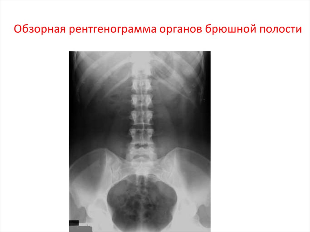 Рентгенография брюшной полости. Обзорная рентгенография органов брюшной полости норма. Обзорный рентген брюшной полости норма. Рентген брюшной полости здорового человека. Обзорная рентгенограмма органов брюшной полости норма.