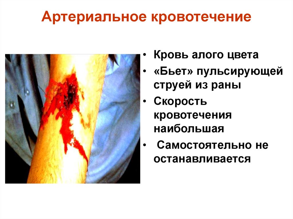 Артериальное кровотечение