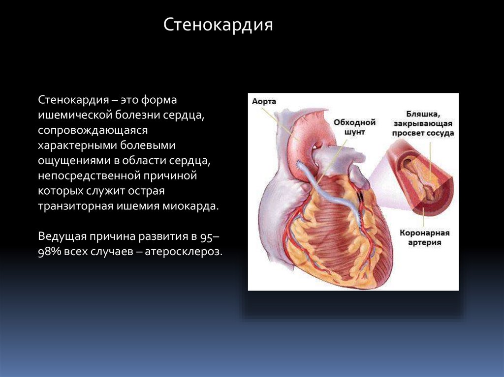 Ибс нестабильная стенокардия карта вызова скорой медицинской