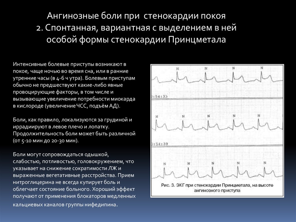 Вариантная стенокардия принцметала. Вазоспастическая стенокардия Принцметала на ЭКГ.