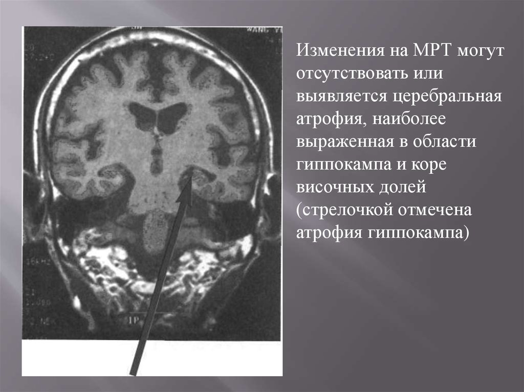 Умеренная атрофия мозга