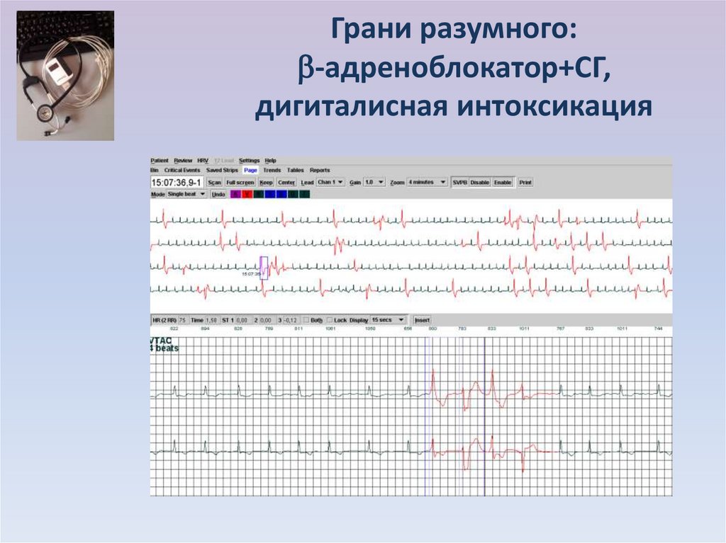 Фибрилляция предсердий карта вызова скорой