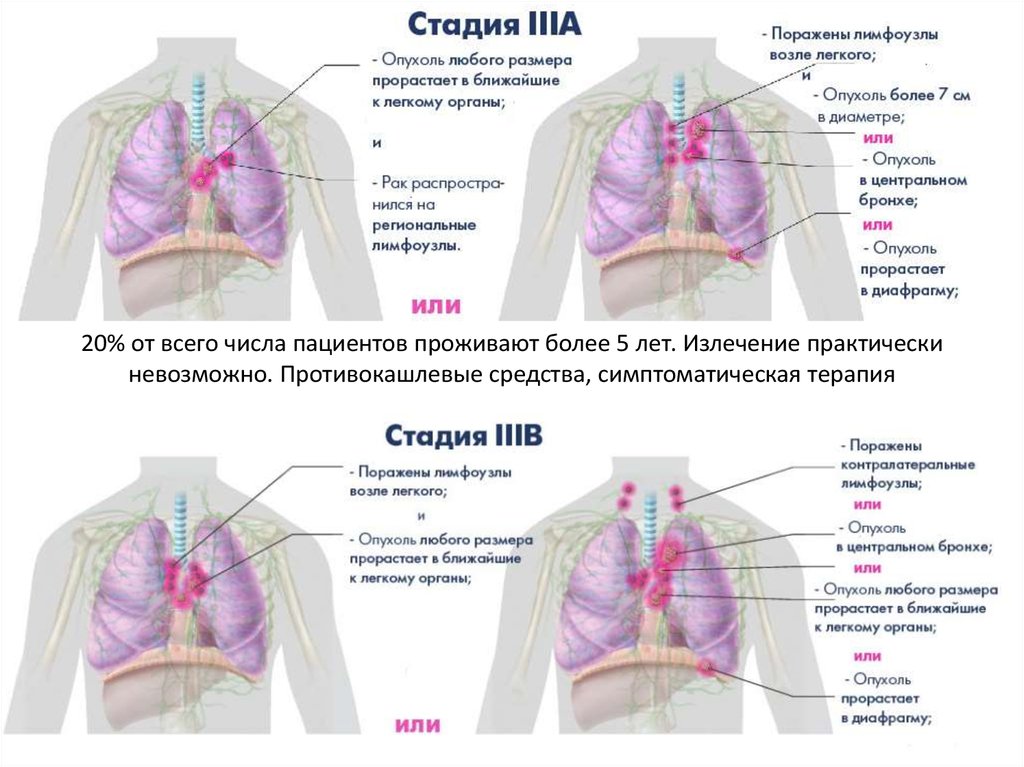 Рак легкого презентация