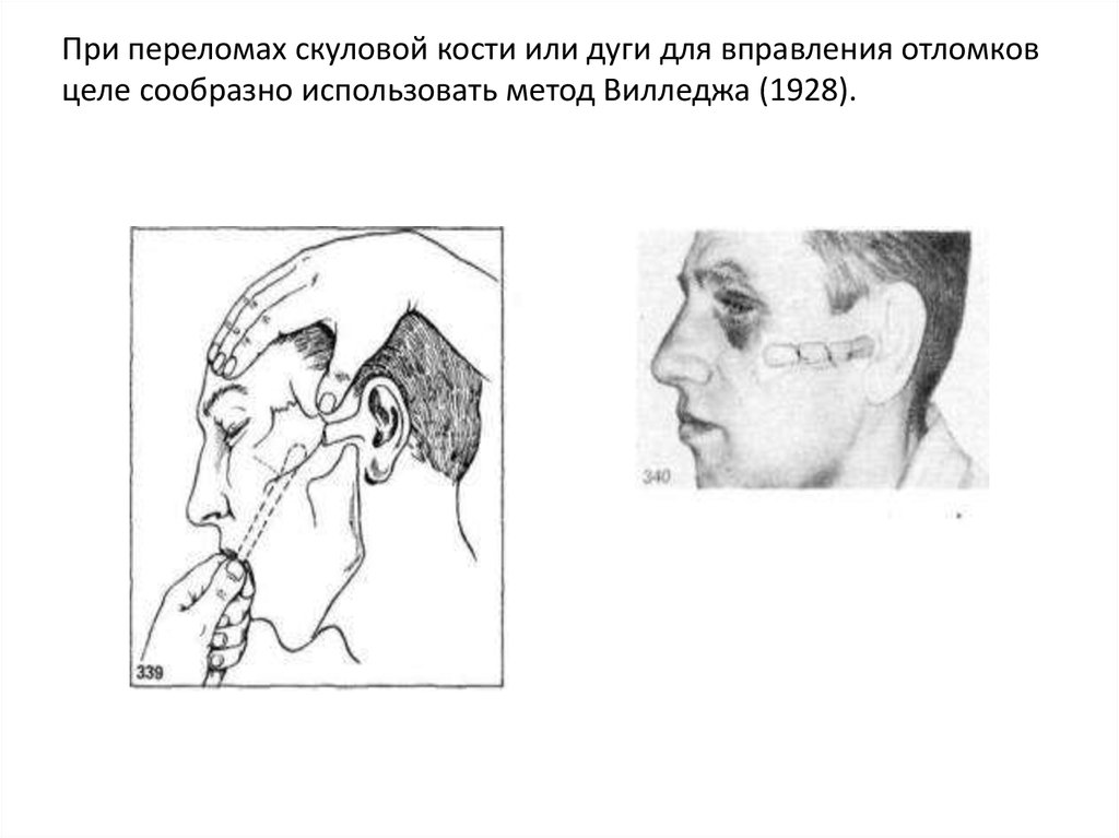 Переломы скуловой кости и дуги презентация