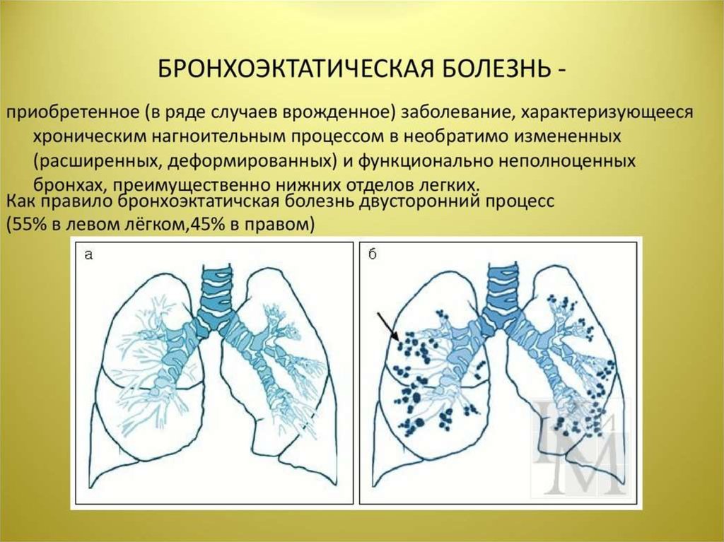 Бронхоэктатическая болезнь клиническая картина