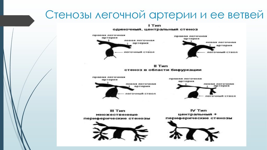 Стеноз легочной артерии. Стенозы легочной артерии и ее ветвей. Аномалии кровеносных и лимфатических сосудов легких. Сужение ветви легочной артерии. Стеноз ветвей легочной артерии.