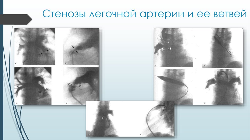 Агенезия венозного. Врожденный стеноз легочной артерии рентгенография. Стенозы легочной артерии и ее ветвей. Сужение легочной артерии. Аномалия легочных сосудов.