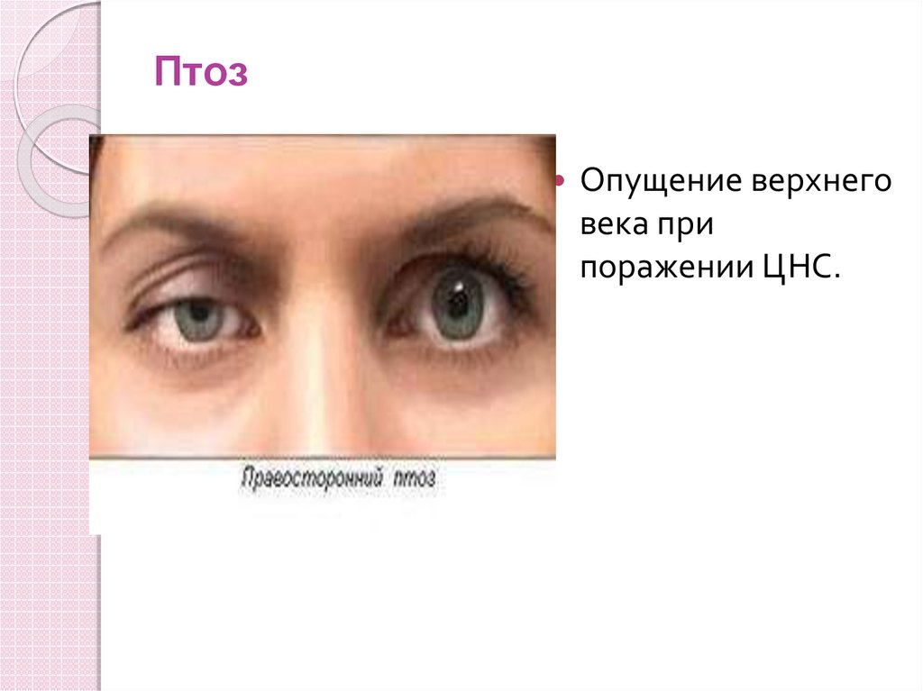 Птоз это. Классификация птоза верхнего века по степени. Птоз 1-2 степени верхнего века. Птоз верхнего века мкб-10 код. Птоз 2 степени верхнего века.
