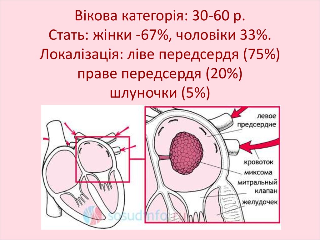 Вікова категорія: 30-60 р. Стать: жінки -67%, чоловіки 33%. Локалізація: ліве передсердя (75%) праве передсердя (20%) шлуночки