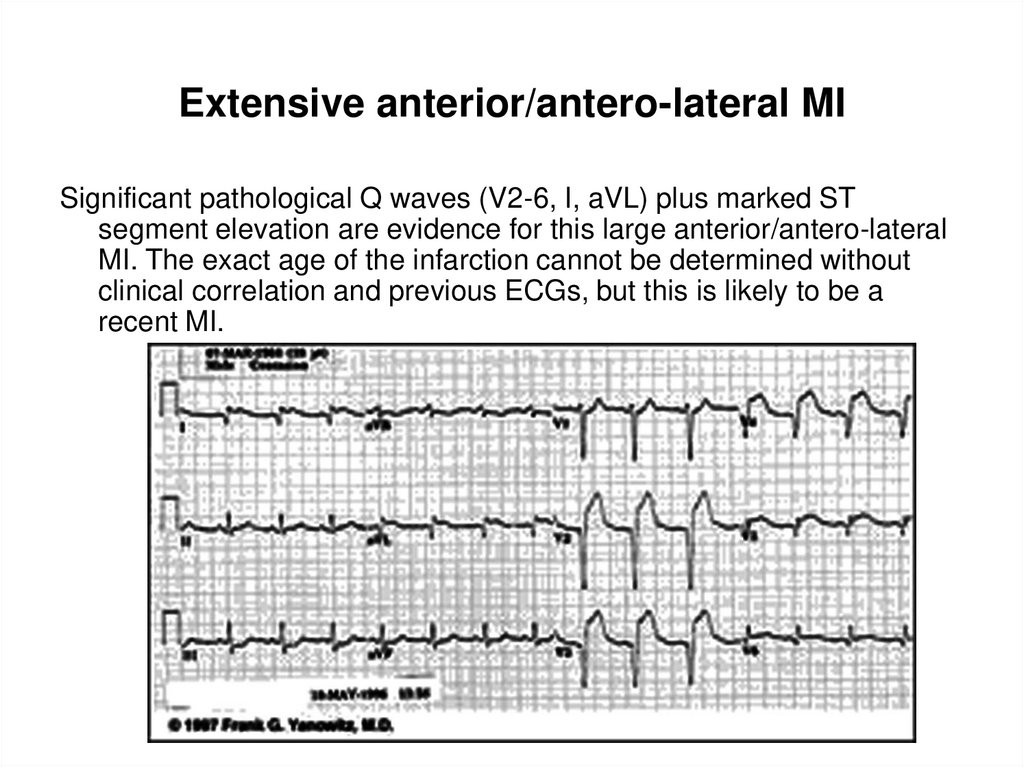 Extensive anterior/antero-lateral MI