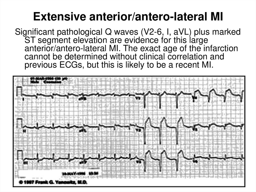 Extensive anterior/antero-lateral MI
