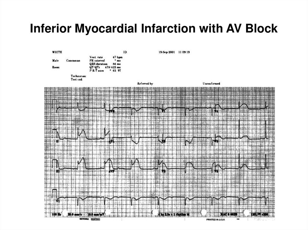 Inferior Myocardial Infarction with AV Block