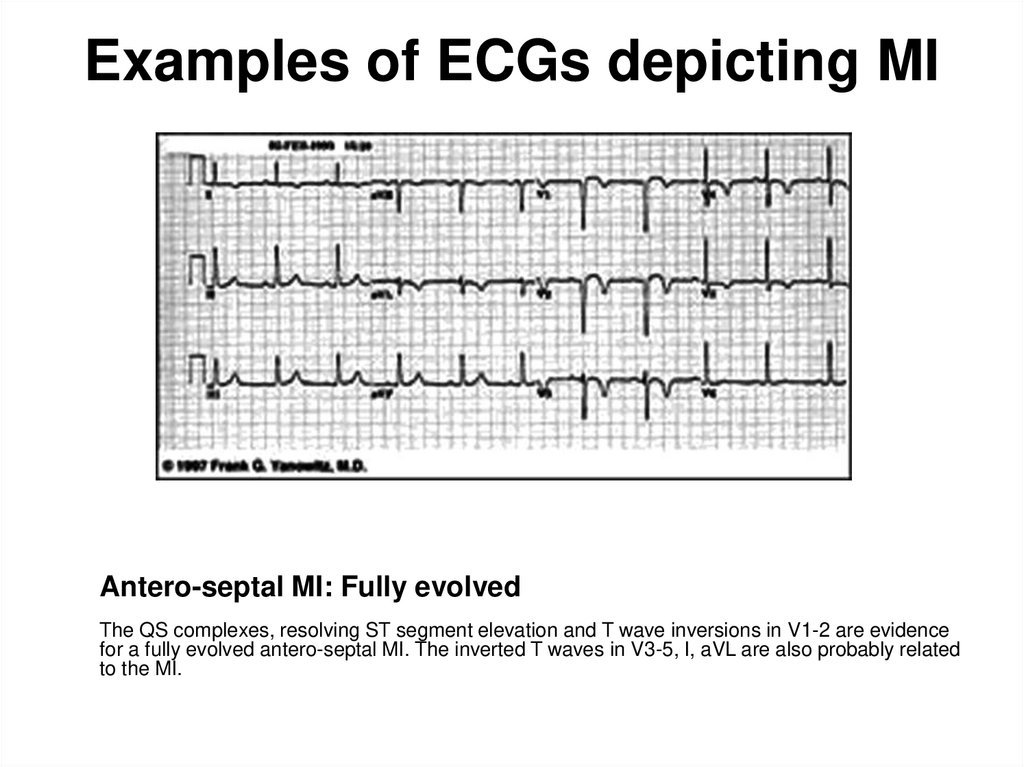Examples of ECGs depicting MI