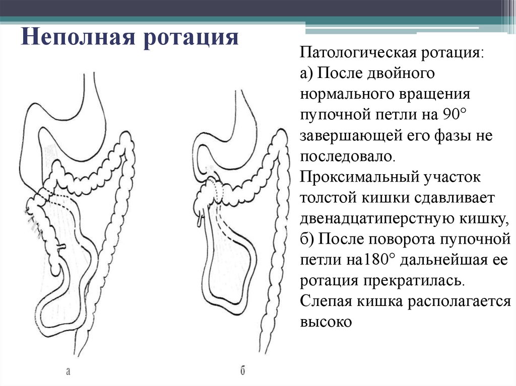 После двойного. Патологическая ротация. Неполная ротация толстой кишки. Неполная ротация слепой кишки. Частичной ротации.