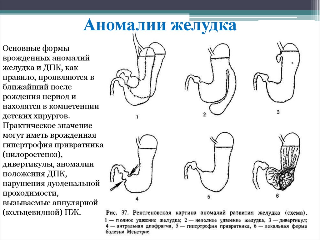 Положение желудка. Формы желудка анатомия. Аномалии и пороки развития органов пищеварительной системы. Аномалии развития органов пищеварительной системы. Каскадная форма желудка.