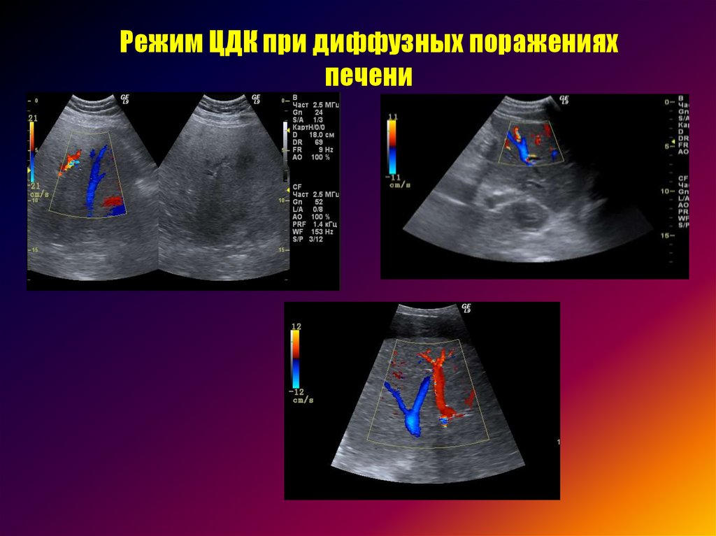 Диффузная печень форум