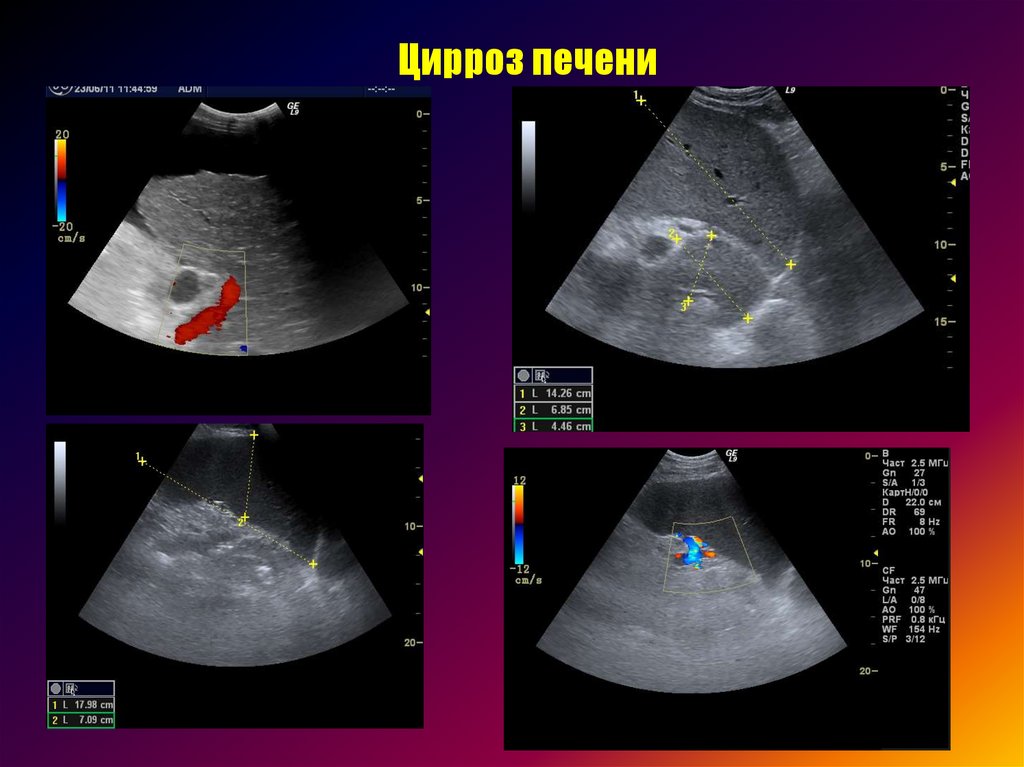 Увидит ли узи цирроз печени