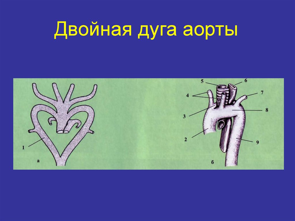 Кольцо аорта. Сосудистое кольцо двойная дуга аорты. Дуга аорты. Двойная дуга аорты у плода.