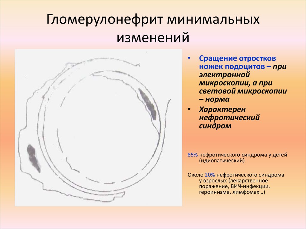 Минимальных изменений. Гломерулонефрит с минимальными изменениями. Болезнь минимальных изменений гломерулонефрит. Гломерулонефрит с минимальными изменениями схема. Минимальный изменения при гломерулонефрите.