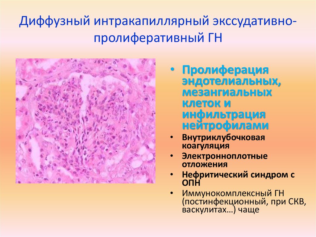 Пролиферативный. Эндокапиллярный гломерулонефрит. Эндокапиллярный пролиферативный гломерулонефрит. Диффузный пролиферативный гломерулонефрит. Диффузный эндокапиллярный пролиферативный гломерулонефрит.