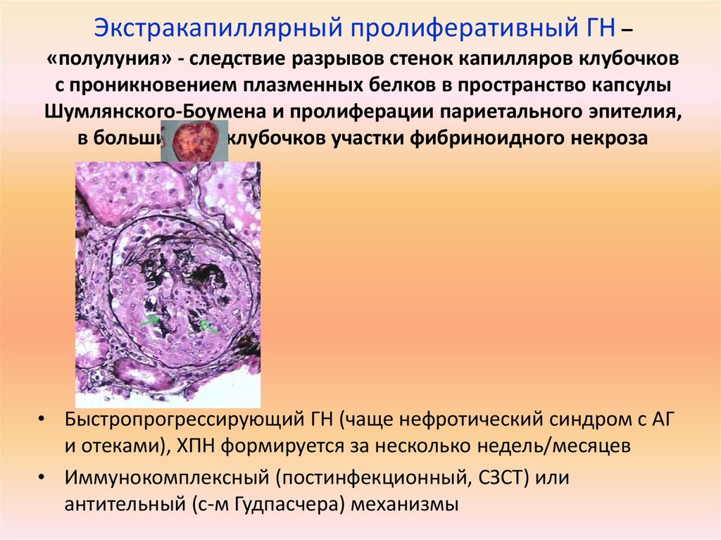 Пролиферативный