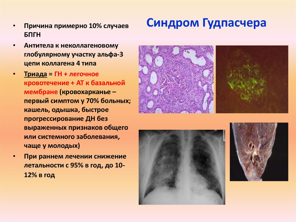 Синдром гудпасчера презентация