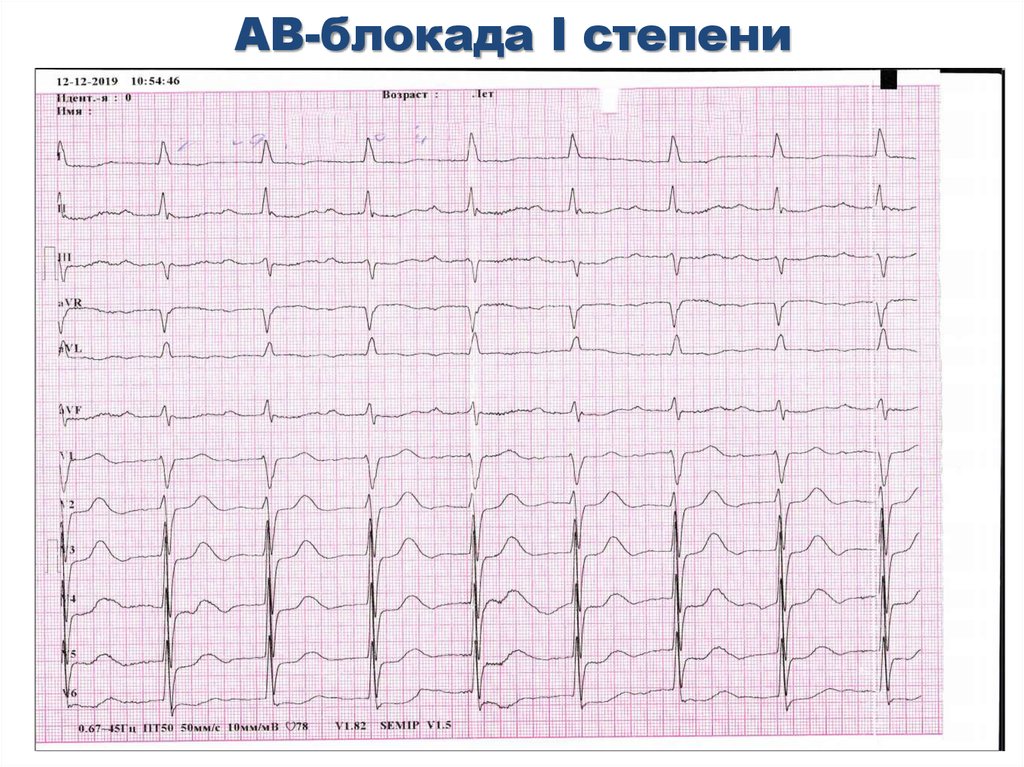 Блокада на первом. ЭКГ при АВ блокаде 1 степени. АВ блокада 1 степени на ЭКГ. А-В блокада 1 степени на ЭКГ. Неполная АВ блокада 1 степени на ЭКГ.