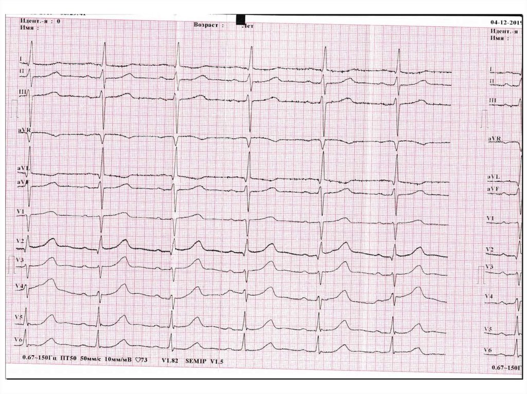 Миграция водителя ритма код мкб. Миграция водителя ритма на ЭКГ. ЭКГ презентация. Левограмма на ЭКГ. ЭКГ картирование сердца.
