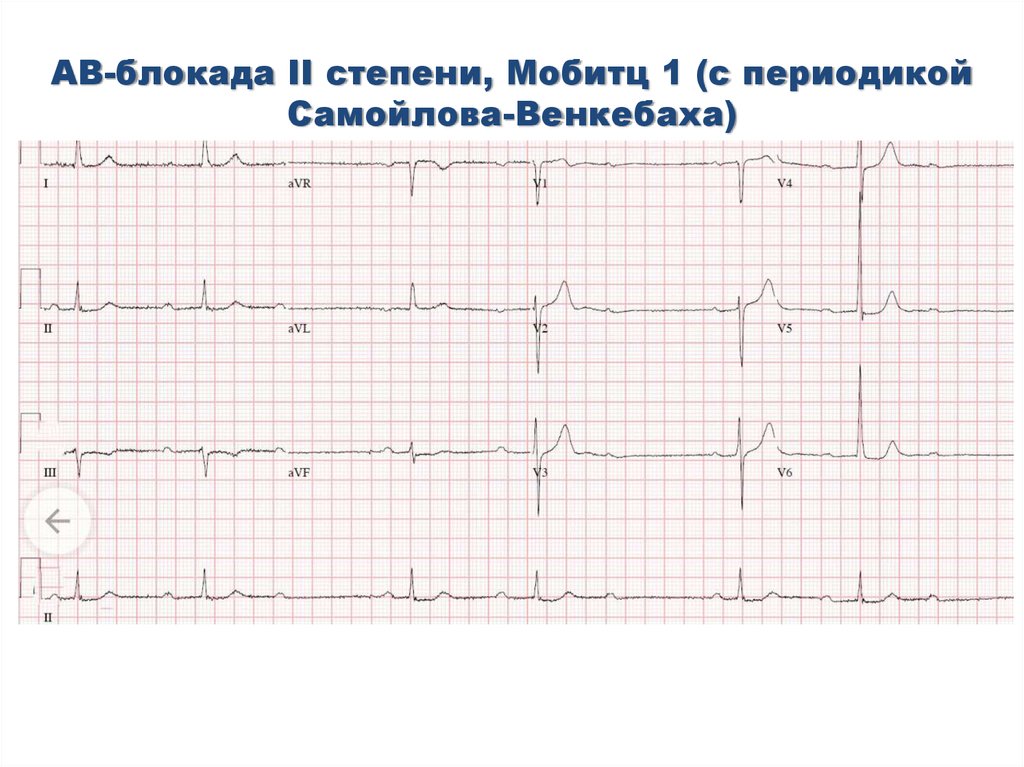 Ав блокада 2. Av блокада Мобитц 1 ЭКГ. Атриовентрикулярная блокада Мобитц 1 на ЭКГ. АВ блокада Мобитц 2 на ЭКГ. Атриовентрикулярная блокада 2 степени Мобитц 2 на ЭКГ.