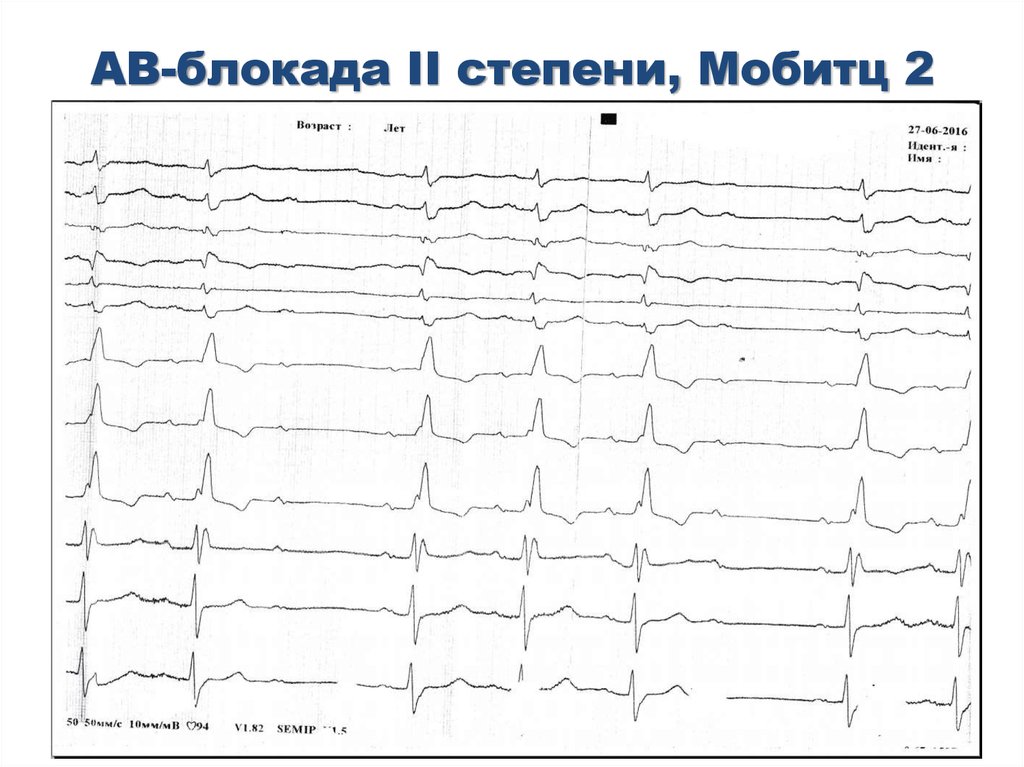 Экг 2. Атриовентрикулярная блокада 2 степени Мобитц 2 на ЭКГ. АВ блокада 2 степени Мобитц 1 на ЭКГ. АВ блокада Мобитц 2 на ЭКГ. Av блокада 2 степени Мобитц 2 на ЭКГ.