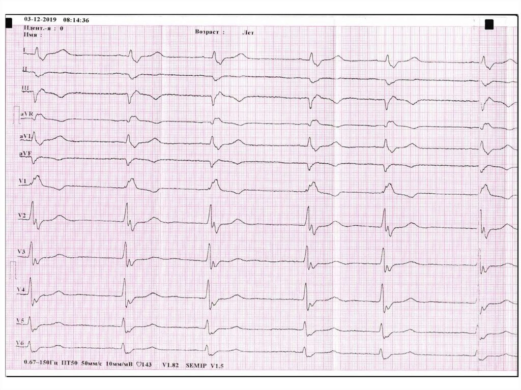 Экг презентация. ЭКГ птиц. R1>r2>r3 ЭКГ. Высоковегитатная ЭКГ. Как сделать копию ЭКГ.