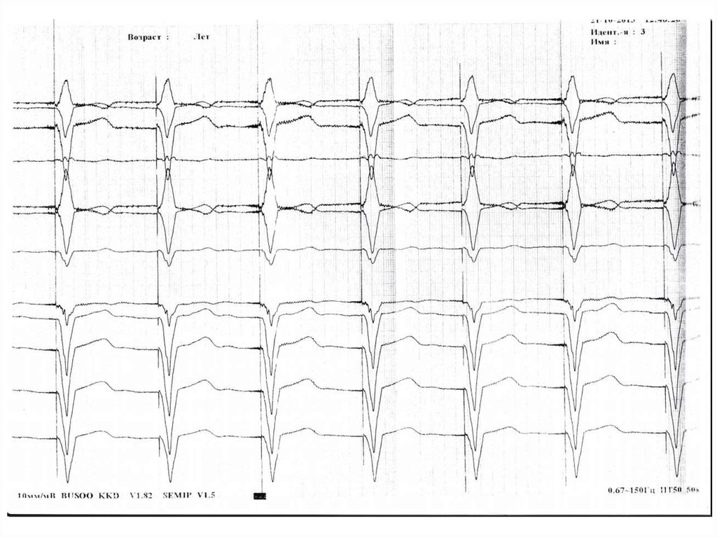 Однокамерный экс. ЭКГ презентация.