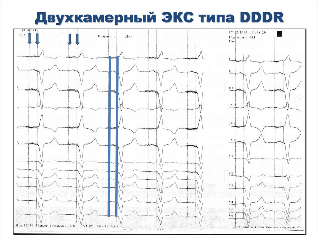 Режимы работы экс. Двухкамерный DDDR на ЭКГ. ЭКГ при двухкамерном экс. Режим стимуляции DDDR.