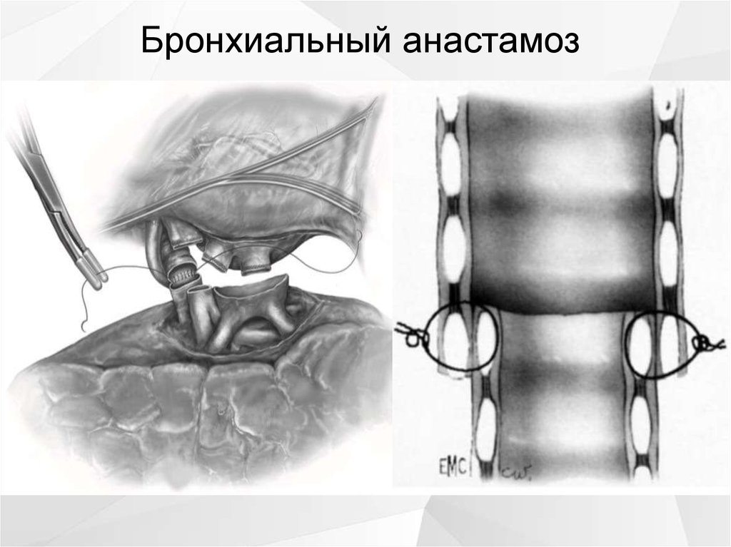 Трансплантация легких презентация