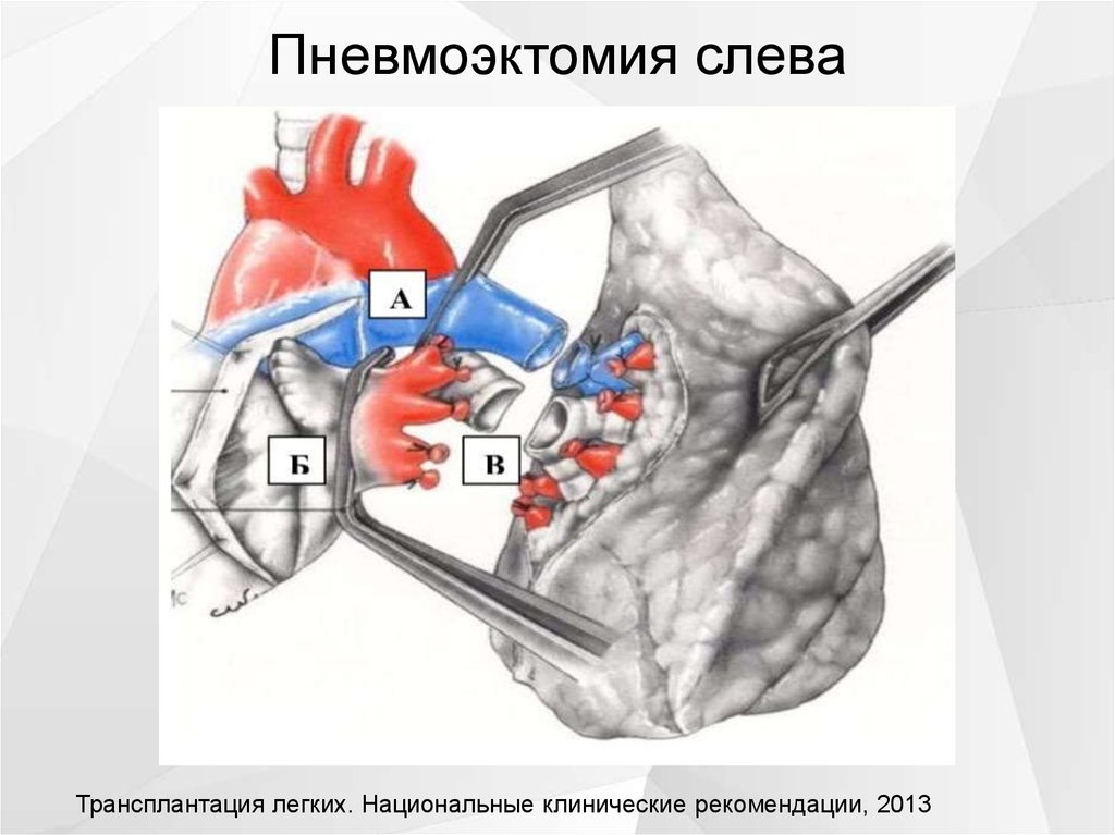 Операции на легких презентация