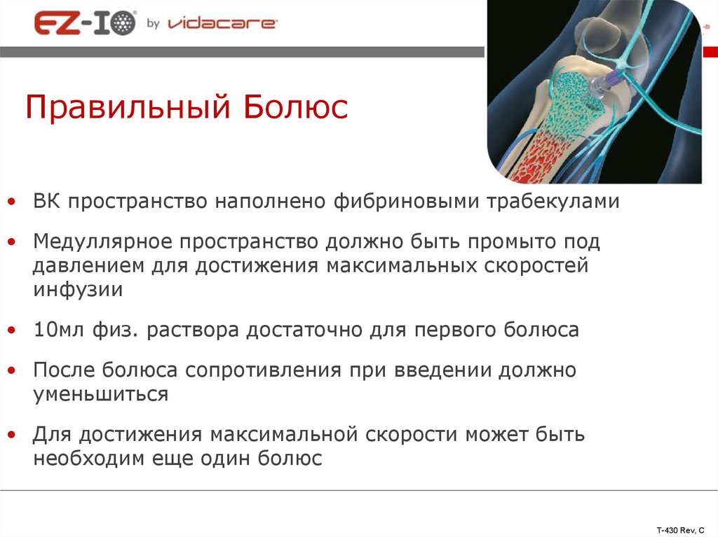 Скорость инфузии ответы. Внутривенное болюсное Введение. Болюсное Введение лекарств. Болюсное Введение препаратов это. Введение препарата болюсом.