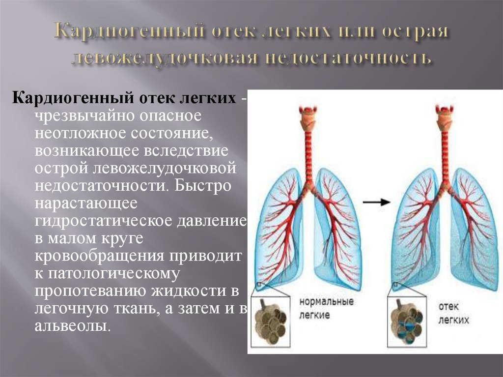 Отечность легких. Механизм кардиогенного отека легких. Кардиогенный отек легких. Кардиагенный отёк лёгких. Кардиогенный отек легких патогенез.