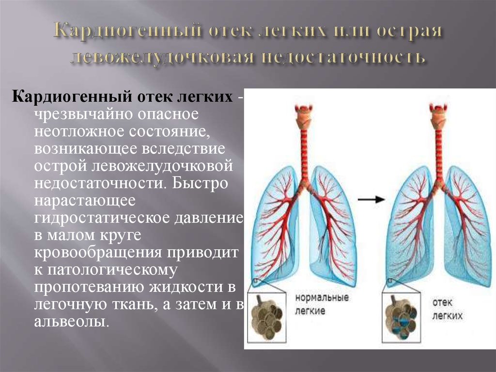 Отек легкого презентация