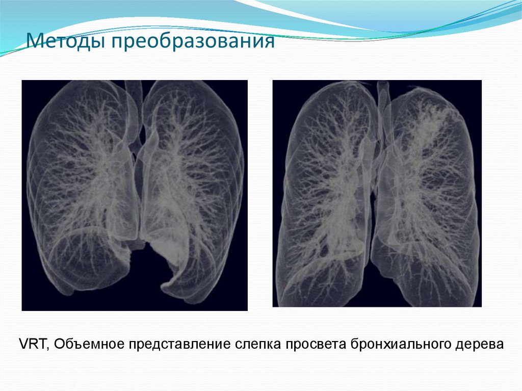 Лучевая диагностика заболеваний легких презентация