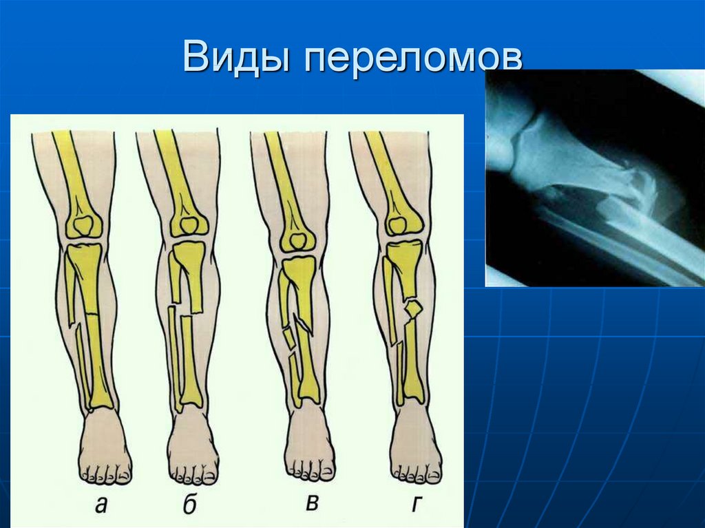 Все виды переломов презентация