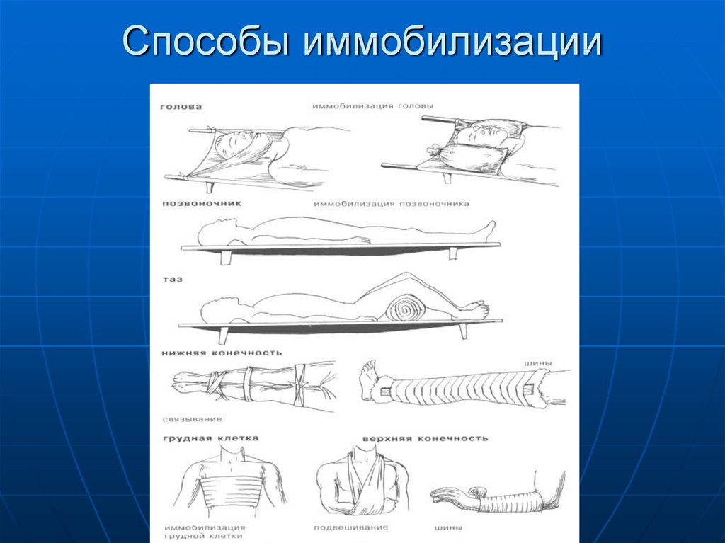 Типы иммобилизации. Способы иммобилизации. Транспортная иммобилизация конечностей. Табельные средства иммобилизации. Иммобилизация подручными средствами.