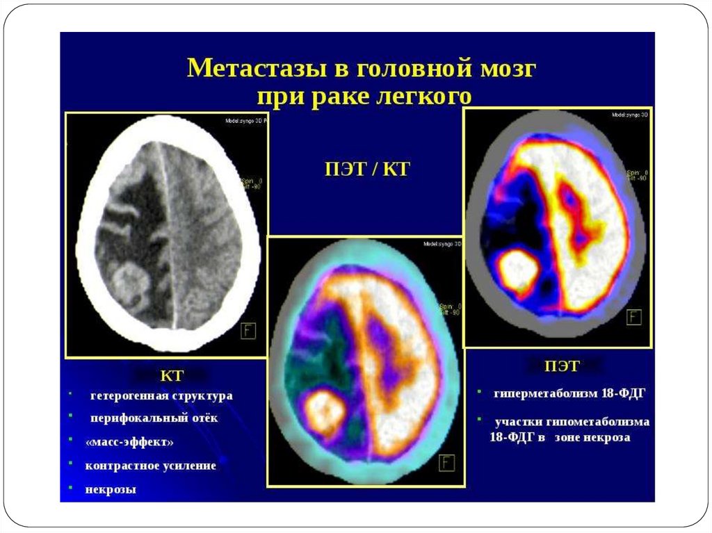 Прогноз жизни при метастазах. Метастатические опухоли мозга. Метастаз в головном мозге кт мрт. Метастазы головного мозга кт. Метастазирование опухолей головного мозга.