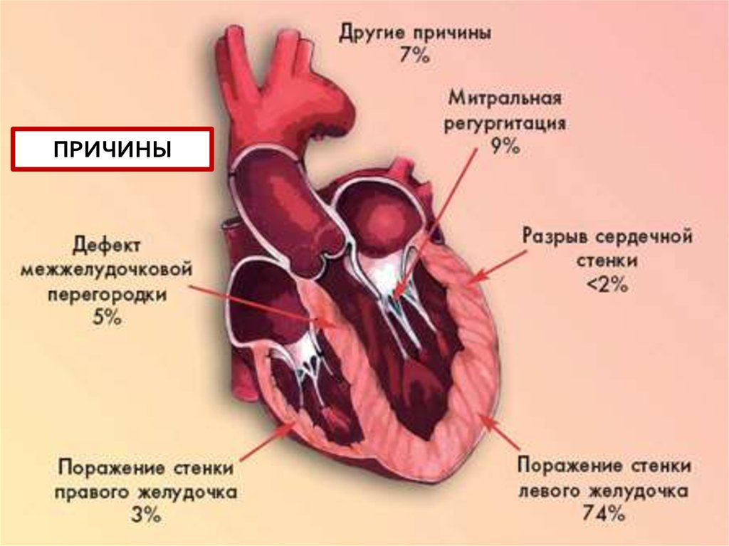 Кардиогенный шок наиболее часто. Сердце при кардиогенном шоке. Кардиогенный ШОК презентация. Кардиогенный ШОК этиология. Причины развития миокардита.