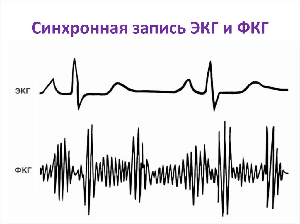 Запись одновременная. ФКГ 1 тон. ЭКГ при трикуспидальном стенозе. Графическое изображение ФКГ. Тоны сердца на ФКГ.