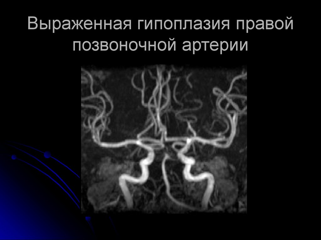 Гипоплазия правой артерии мозга. МРА картина гипоплазии v4 сегмента правой позвоночной артерии что это. Гипоплазия v4 позвоночной артерии. V4 позвоночной артерии. Гипоплазия позвоночной артерии кт.