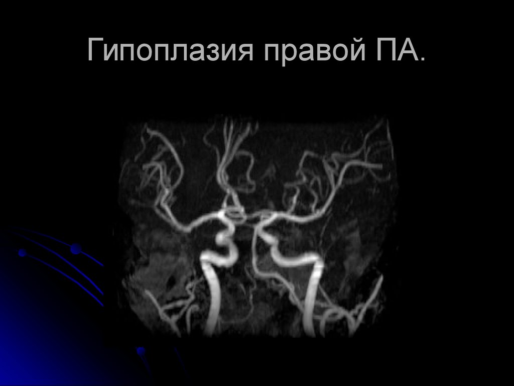 Сегмент а1 пма. Гипоплазия позвоночной артерии мрт. Гипоплазия правой позвоночной артерии мрт. Аплазия позвоночной артерии. Гипоплазия правой передней передней мозговой артерии.
